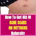 How To Get Rid Of Acne Scars On Buttocks Naturally