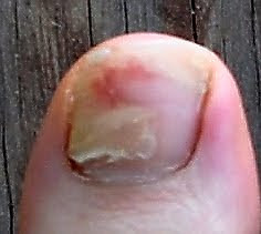Walks with Moss: My toenail