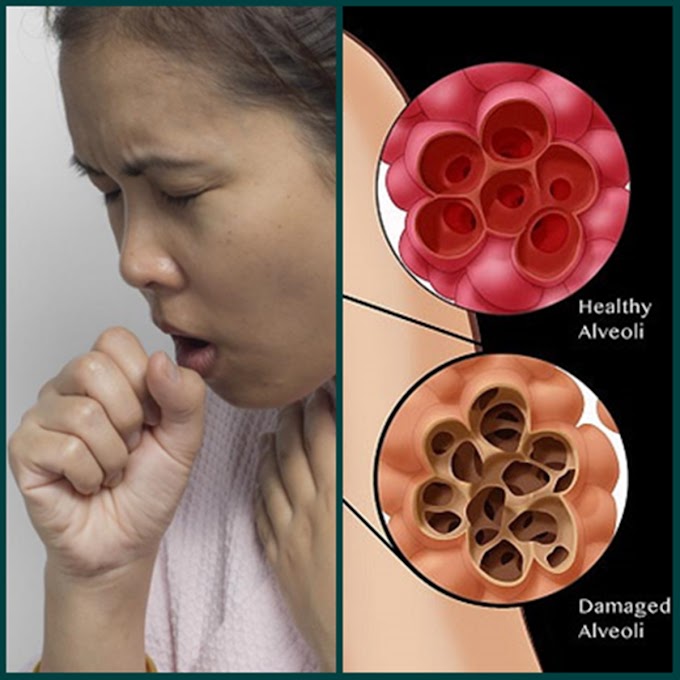 How to deal with Emphysema and its treatment by using natural remedies