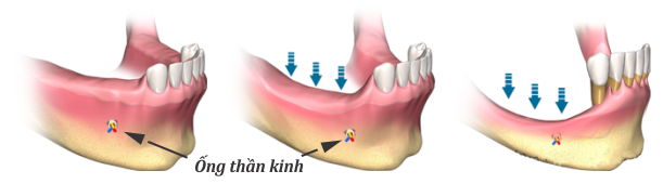 Ghép xương trong Implant cần thiết để đảm bảo hiệu quả trồng răng Implant