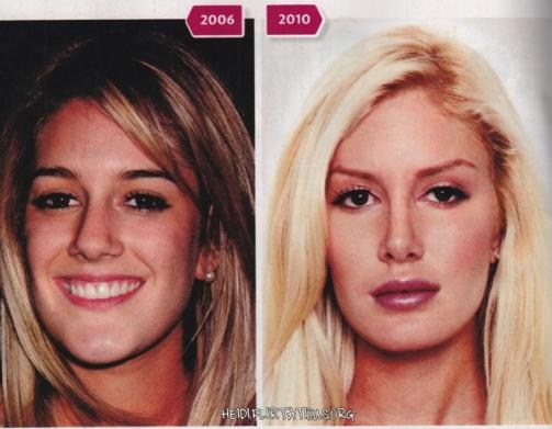 heidi montag before and after 10 surgeries. makeup Heidi Montag Plastic