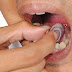 Cách chữa đau mọc răng khôn từ tự nhiên