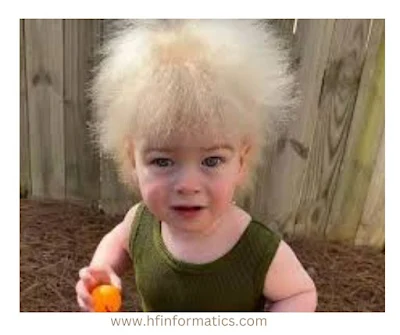 Uncombable Hair Syndrome:  hfinformatics