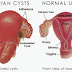 Tanda-Tanda Ovarian Cyst