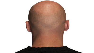 male pattern baldness,