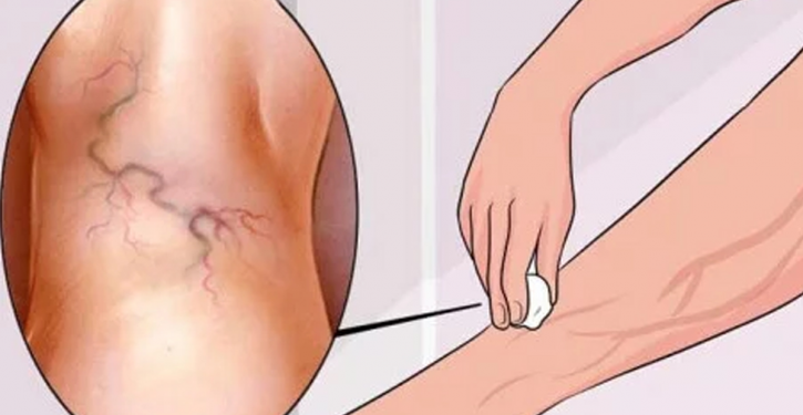 8 Simple Exercises To Treat Varicose Veins