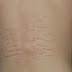 Macam-Macam Minyak Untuk Memudarkan Stretch Mark