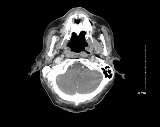 cancer-nose-paranasal-sinuses-CT-Scan