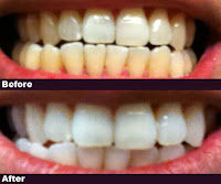 3d Whitestrips1