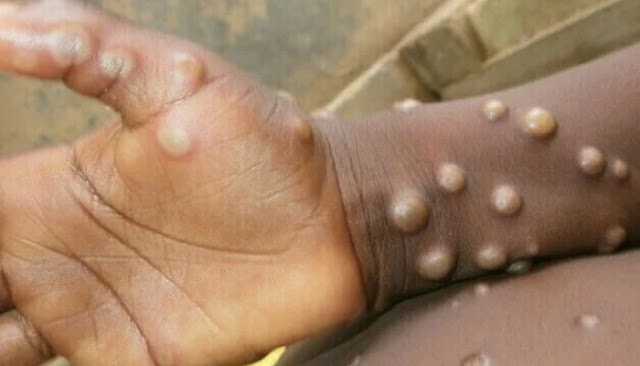 Pakistan is on high alert after monkey pox cases were discovered in the UK and the US.