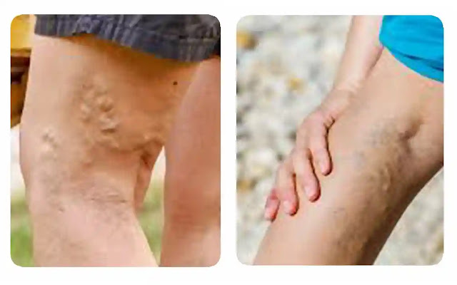 Unveiling the Vein Chronicles A Guide to Medical Marvels for Varicose Veins