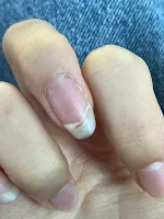 실제 손톱이 부러진 경우