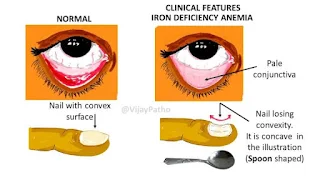 ANEMIA SYMPTOMS AND CARE DETAIL