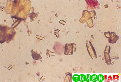 Uric acid, barrel shape, and yeast in the background