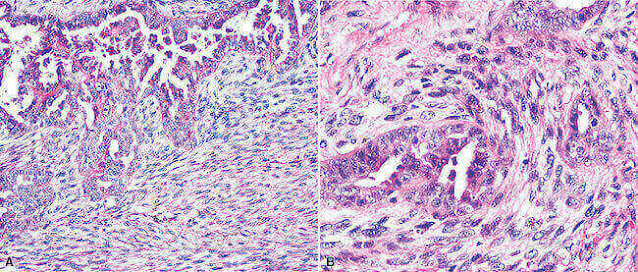 Epithelioid Mesothelioma