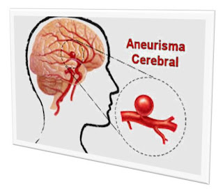 Gb. penyakit aneurisma otak adalah aorta abdominalis