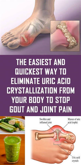 The Easiest & Quickest Way To Eliminate Uric Acid Crystallization From Your Body To Stop Gout & Joint Pain