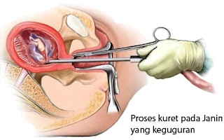 cara cepat hamil setelah kuret