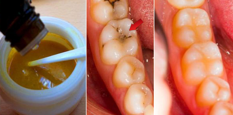 Naturally Caring For Your Tooth Decay And Teeth Damage With This Powerful Remedy