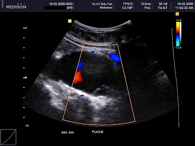 gallbladder ultrasound pictures. Ultrasound showed a large