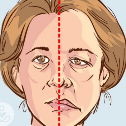 stroke hemoragik sembuh
