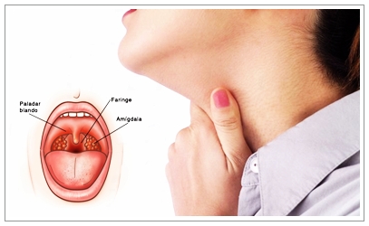 Cara Menyembuhkan Faringitis Secara Alami