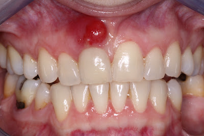 tooth abscess