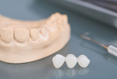 Phục hình răng sứ có hại không? 