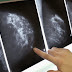Filipino Doctor Reveals Breast Cancer “Highly Curable”