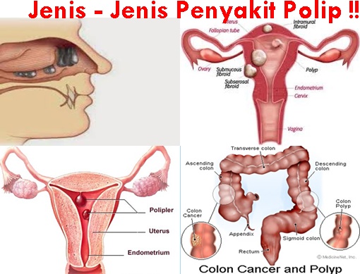 Tips Ampuh Dalam Mengatasi Penyakit Polip Secara Alami