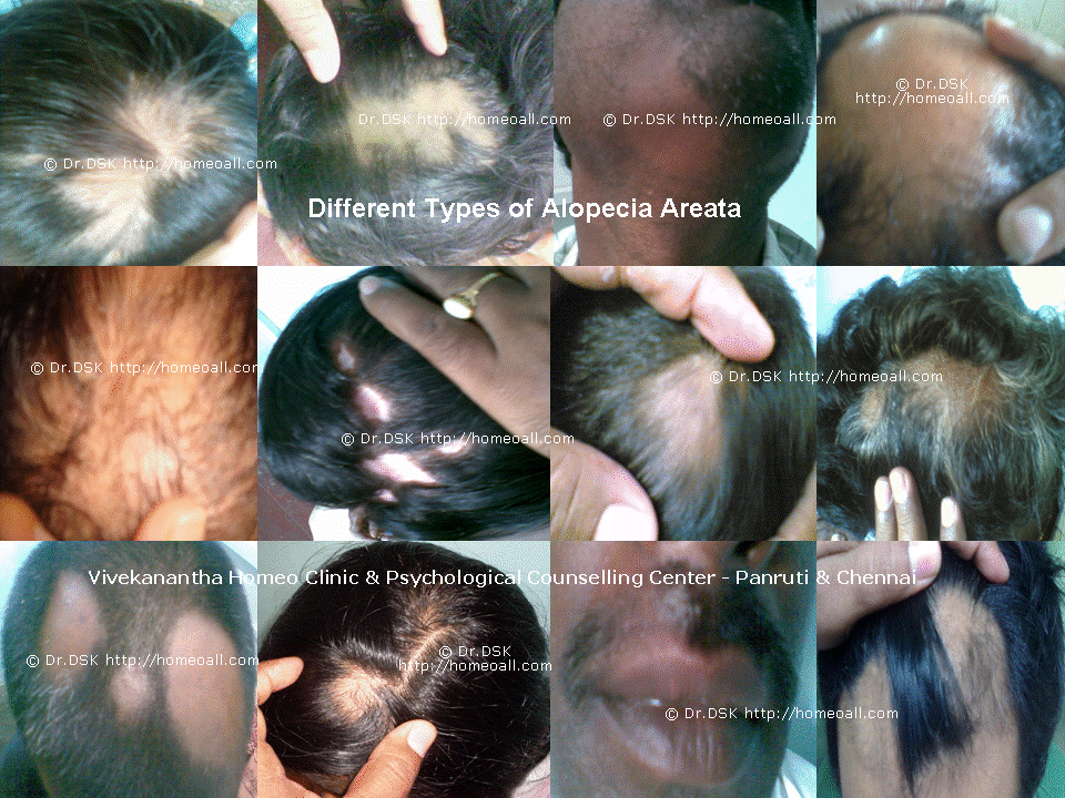  alopecia areata specialty treatment hospital at chennai