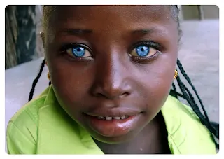 Africans With Dark Skin And Unusually Bright Blue Eyes