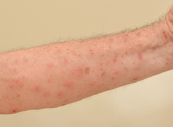 Ways to treat and avoid Scabies (The itch) using natural remedies.