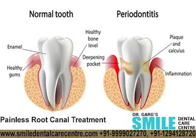 Painless Root Canal Treatment in Faridabad