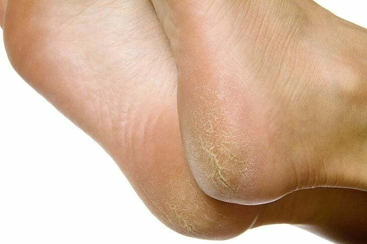 Dry feet and cracked heels? The magic trick to repair them and make them soft in minutes