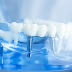 Trồng răng implant giá rẻ