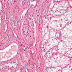 Renal cell carcinoma