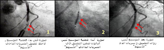 مرض نقص التروية القلبية الذبحة الصدرية Heart Disease Angina Pectoris