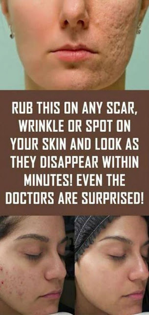 Rub This On Any Scar, Wrinkle Or Spot On Your Skin And Look As They Disappear Within Minutes! Even The Doctors Are Surprised!