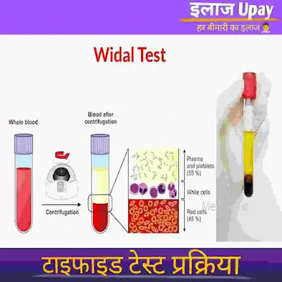 widal test in hindi , widal test positive means in hindi , typhi o positive means in hindi , typhi h positive means in hindi , widal test kit , typhoid test report , typhoid test ,