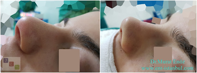 Natural nose reshaping,Natural nose job,Natural rhinoplasty in Istanbul,Natural looking rhinoplasty,Natural rhinoplasty in Turkey,Natural rhinoplasty techniques,Natural nose job in Istanbul,