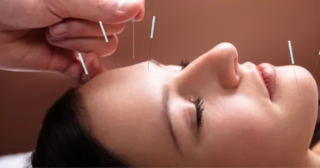 Fertility Acupuncture