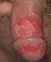 herpes genital en el pene