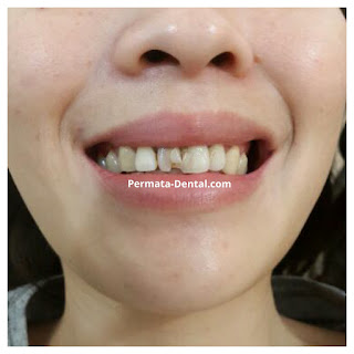 foto, gambar, gigi depan keropos Permata Dental Bali| sebelum dan sesudah gigi keropos diperbaiki di Permata Dental Bali | foto gigi keropos hitam Permata Dental Bali |gigi keropos karena sakit | gigi keropos berlubang | gigi keropos depan| gigi keropos bagian belakang | foto gigi keropos yang sudah diperbaiki Permata Dental Bali |  gigi keropos bagian depan| foto gigi keropos dan patah, foto gigi keropos oleh Permata Dental Bali, Bali Hits, Bali banget, area Bali, Bali kota, area kampus bali. veneer gigi keropos  Bali | veneer gigi keropos badung | veneer gigi keropos nusadua | veneer gigi keropos ngurahrai| veneer gigi keropos denpasar | veneer gigi kropos denpasar kota | veneer gigi keropos Bali | veneer gigi keropos gatsu | |veneer gigi keropos|  depan | veneer gigi keropos  atas | veneer gigi keropos  bawah | veneer gigi keropos  belakang |veneer gigi berlubang bali| veneer gigi berlubang Bali | veneer gigi berlubang nusadua| veneer gigi berlubang ngurahrai| veneer gigi berlubang Badung | veneer gigi berlubang depasar kota | veneer gigi berlubang denpasar| veneer gigi berlubang gatsu| veneer gigi berlubang jimbaran| veneer gigi berlubang bagus Permata Dental Bali | veneer gigi berlubang baik di Permata Dental Bali | veneer gigi berlubang cepat di Permata Dental Bali | veneer gigi berlubang murah di Permata Dental Bali | veneer gigi berlubang aman | veneer gigi berlubang mudah di Permata Dental Bali | veneer gigi berlubang promo Permata Dental Bali | gambar veneer gigi berlubang Permata Dental Bali | gambar sebelum dan sesudah veneer gigi hitam dan berlubang  veneer gigi hitam Bali | veneer gigi hitam Bali | veneer gigi hitam denpasar | veneer gigi hitam jimbaran | veneer gigi hitam nusadua | veneer gigi hitam Bali kota | veneer gigi hitam ngurahrai| veneer gigi hitam badung | veneer gigi hitam gatsu | veneer gigi hitam bagus | veneer gigi hitam baik | veneer gigi hitam cepat di Permata Dental Bali | veneer gigi hitam murah di Permata Dental Bali | veneer gigi hitam aman | veneer gigi hitam mudah di Permata Dental Bali | veneer gigi hitam promo Permata Dental Bali | gambar veneer gigi hitam Permata Dental Bali | gambar sebelum dan sesudah veneer gigi hitam dan berlubang Permata Dental