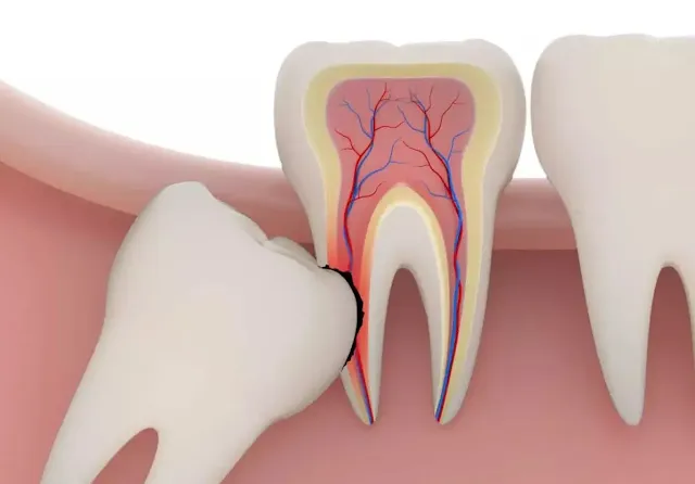 A wisdom teeth affecting another teeth