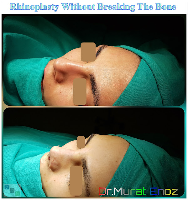 Rhinoplasty Operation Without Breaking The Nasal Bone