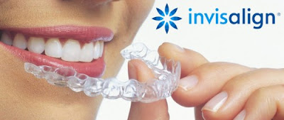 Niềng răng vô hình Invisalign có tính thẩm mỹ cao