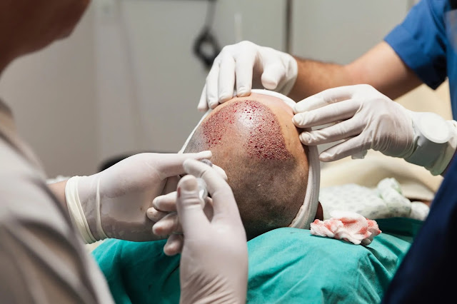 Enriched FUE Hair Transplant Technique in Delhi