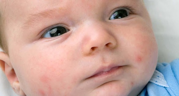 All You Need to Know about Baby Pimples