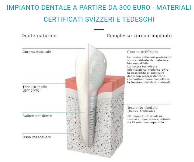 IMPIANTO DENTALE A PARTIRE DA 300 EURO - MATERIALI CERTIFICATI SVIZZERI E TEDESCHI